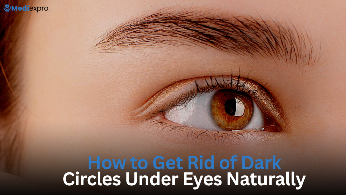How to Get Rid of Dark Circles Under Eyes Naturally