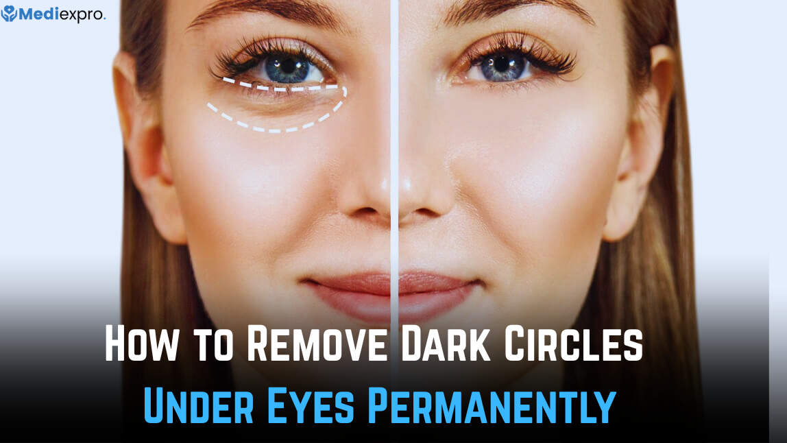 How to Remove Dark Circles Under Eyes Permanently
