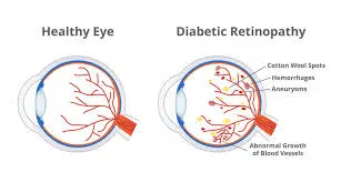 Retinopathy Treatment in Diabetes