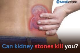 Can kidney stones kill you 1