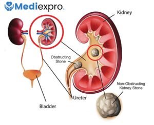 How Long Do Kidney Stones Last